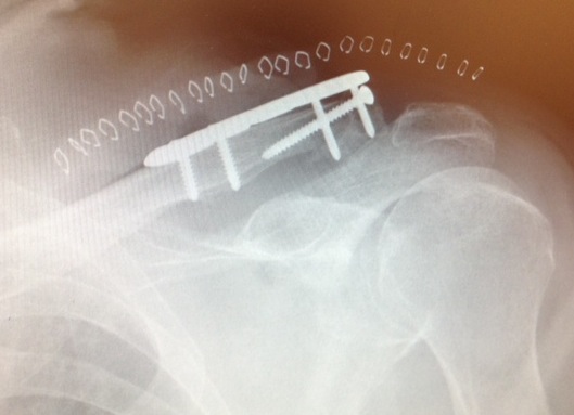 Lateral Clavicle ORIF 2